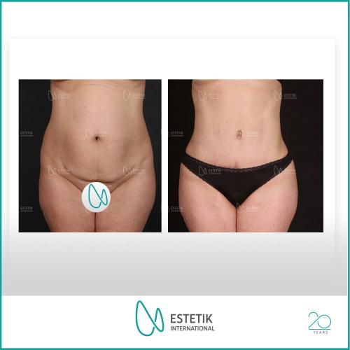 Traitement de la Gynécomastie (avec liposuccion) Photos avant & après